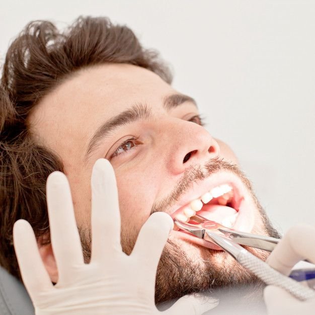 Tooth Extraction for Implants