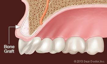 Bone Grafting Procedure