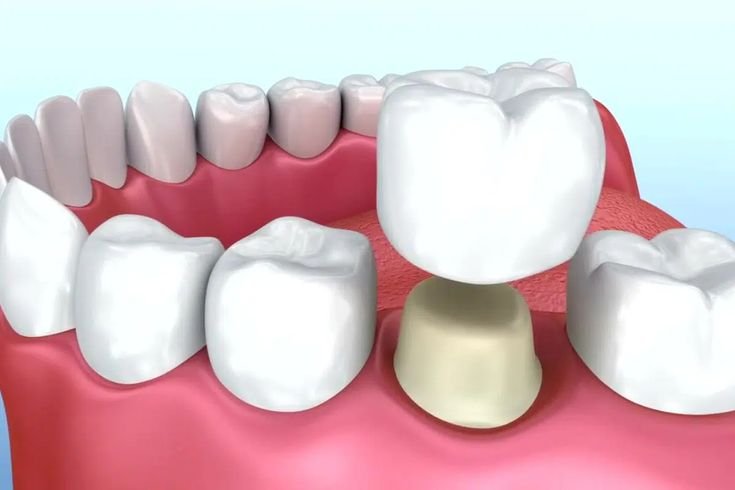 Crown Placement on Implant