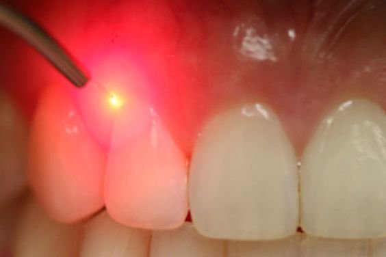 Dental Laser