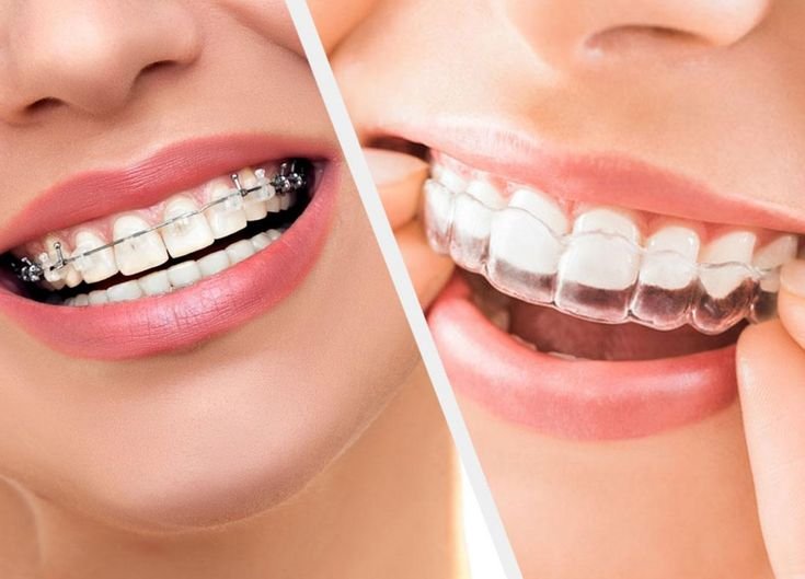 Orthodontic Treatment